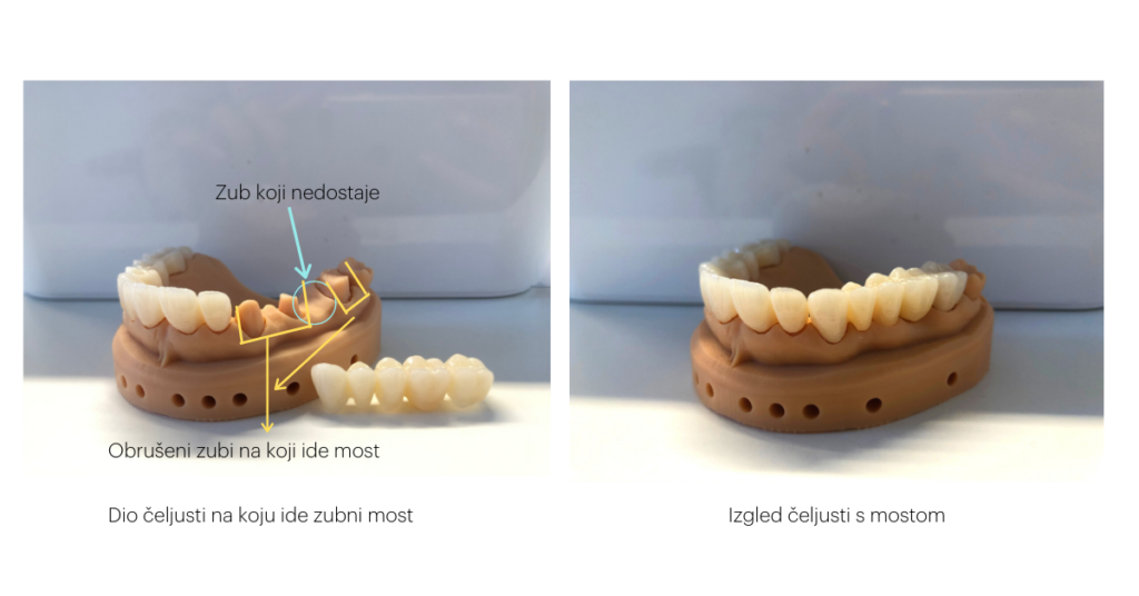zubni most prije i poslije